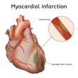 Myocardial infarction. Heart attack. Blocked artery, damaged heart muscle. Anatomy illustration. Red image, white background.