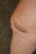 © wandee007 - Scratch on the knee caused by a fall.