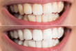 © Andrey Popov - Person Teeth Before And After Whitening
