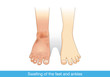 Swelling of the feet and ankles from infected or injury other. Illustration about medical.