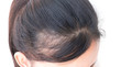 © mraoraor - Woman serious hair loss problem for health care shampoo and beau