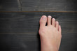 © mukku - Hallux valgus, bunion in foot