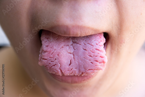 Fotografie, Obraz Bacterial infection disease tongue,The tongue is thrush.Tongue w