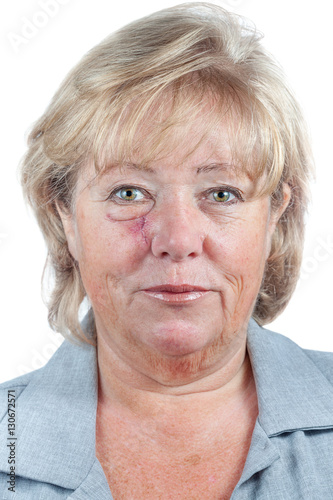 Рак кожи: симптомы и признаки, как выглядит рак кожи на начальной стадии, причин