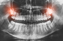 Closeup Of X-ray Image Growing Wisdom Teeth Pain Concept.