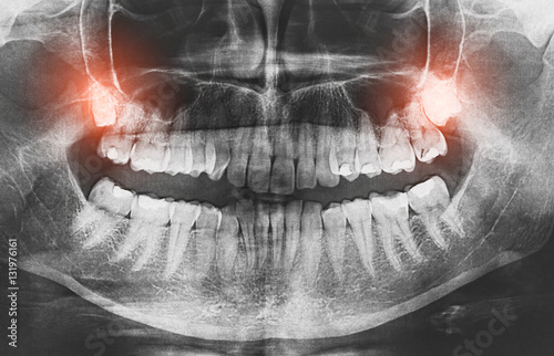 Fotografía Closeup of x-ray image growing wisdom teeth pain concept.