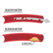 healthy artery and blocked artery
