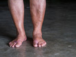 The varicose veins on a legs