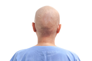 Hair loss patient after chemotherapy on white background isolated