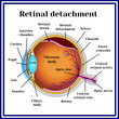Retinal detachment. Detachment of the retina from choroid.