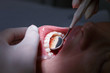 Patient getting her interdental spaces examined