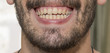 The bearded man smiles, showing bad teeth.