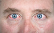 Closeup of bloodshot eyes