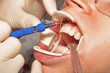 Dental hygiene and beauty procedures in the dental office, close up of teeth whitening treatment