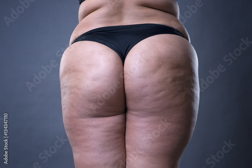 Fotografie, Obraz Fat female body with cellulite, fatty hips and buttocks