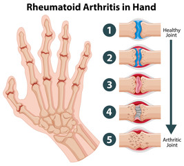 Wall Mural - Diagram showing rheumatoid arthriitis in hand
