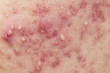 Acne on facial skin,Dermatological disease acne