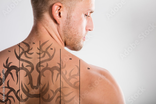 Zdjęcie XXL Laserowe usuwanie tatuaży na plecach mężczyzny