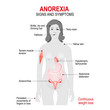 Anorexia nervosa. Signs and symptoms.