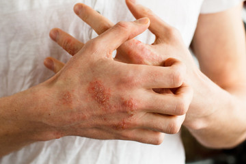 The problem with many people - eczema on hand. White background. Man itchind skin.