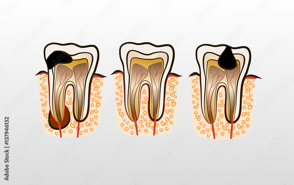 Vector illustration of tooth Decay Caries Stock Vector | Adobe Stock