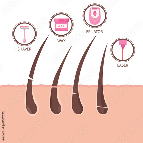 Modern Vector Illustration Of Different Methods Of Hair Removal