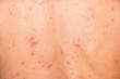 Allergic rash dermatitis eczema skin of patient.