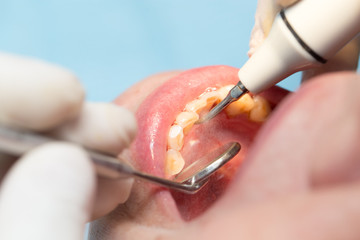 Wall Mural - dental treatment in dentistry