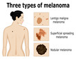 Three types of melanoma