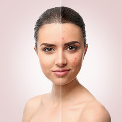 Woman face before and after acne treatment procedure. Skin care concept.