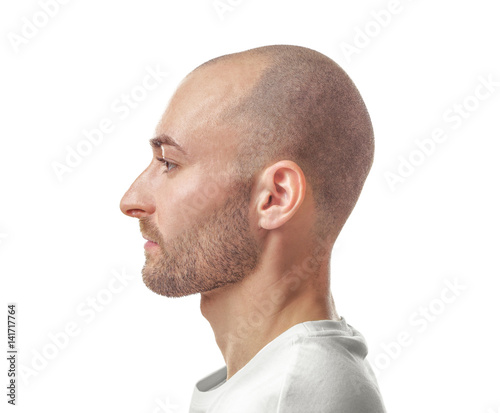 Hair Loss Concept Portrait Of Young Bald Man On White Background