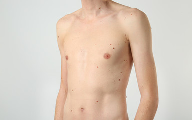 Wall Mural - Young man with birthmarks on light background