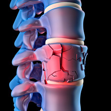  3d Image Of A Spinal Column And A Disk Explosion. Concept Of Pain And Problem Related To Herniated Disc.