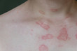 ill allergic rash dermatitis eczema skin of patient,Hot rash