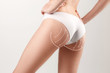© master1305 - The cellulite removal plan. White markings on young woman body