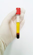 © Chamaiporn - Hand in glove holding normal or yellow serum in clot blood tube. It is good specimen for chemistry and serology test in the laboratory on white backgrounds.