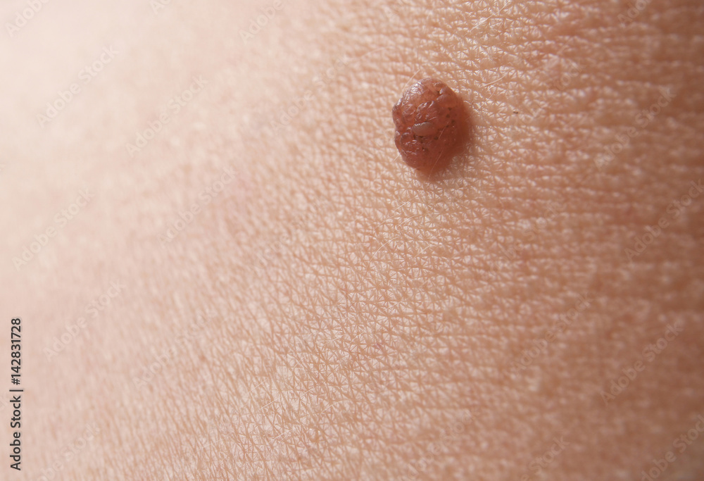Human skin with birthmark, closeup