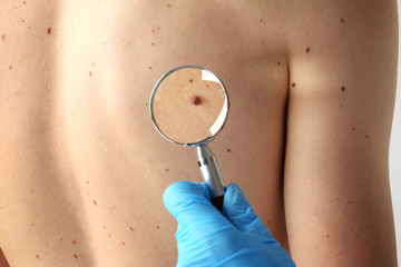 Wall Mural - Dermatologist with magnifier examining patient in clinic, closeup