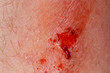 © ungvar - Closeup of wound and dry blood on leg.