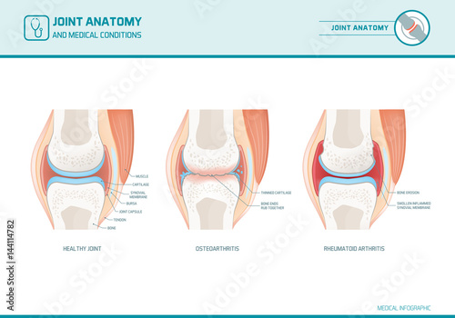Fotografía Joint anatomy, osteoarthritis and rheumatoid arthritis infographic
