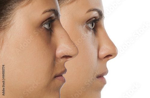 Fotografia  comparative portrait of a young woman before and after nose correction
