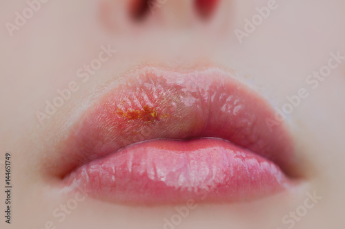 herpes virus on sick female lips therapeutic lip balm infectious lip diseases