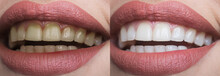 Teeth Whitening At The Dentist. Stomatology And Dental Clinic Concept. Teeth Before And After. White Tooth Smile. White And Yellow Teeth, Plaque Cleaning On Teeth. Whitening Toothpaste, Healthy Teeth