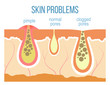 Skin problems - acne, pimples and clogged pores. Skin pores close up. Vector.