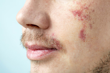 Wall Mural - Young man with birthmarks on light background, closeup