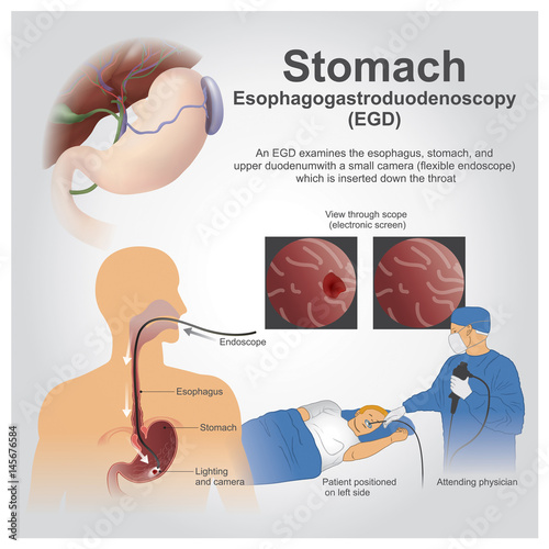 EGD Stomach. Vector graphic. Stock Vector Adobe Stock