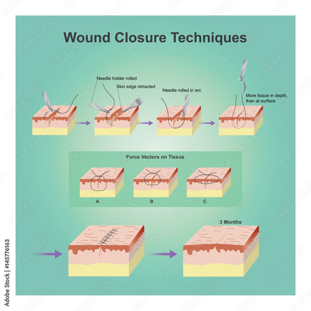 Wound closure techniques.