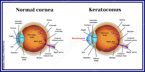 Fotografia, Obraz Keratoconus. Dystrophic disease of the cornea.