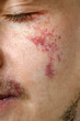 Young man with birthmarks, closeup