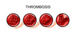 thromboembolism artery. blockage
